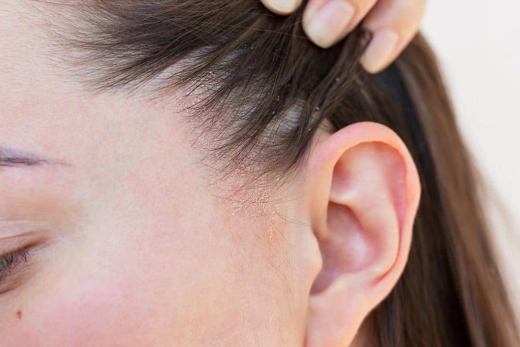 Tratament pentru dermatita seboreica scalp: Ghid de îngrijire și echilibrare (2026)